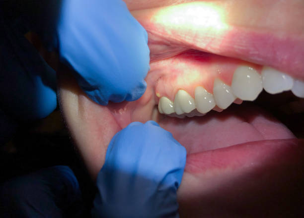 Best Emergency Dental Care for Broken or Chipped Teeth in Northwest Harwinton, CT