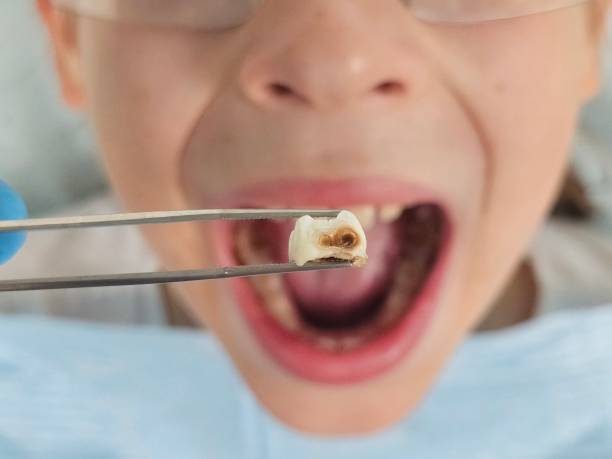 Best Emergency Tooth Extraction in Northwest Harwinton, CT